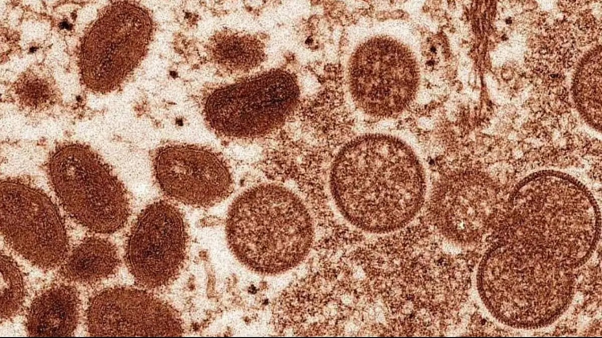 Youngster With Suspected Monkeypox Infection Hospitalised In Kannur