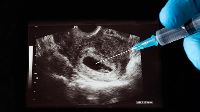 Husband Among Three Booked For Forcing Woman To Undergo Abortion