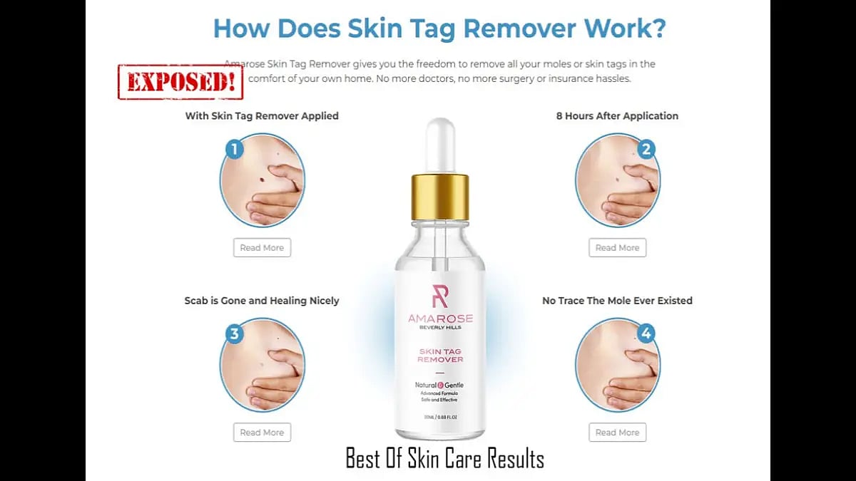 Amarose Skin Tag Remover