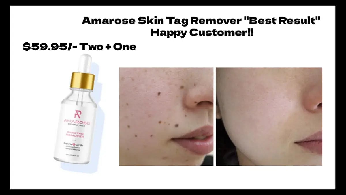Amarose Skin Tag Remover Reviews