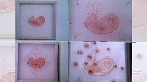 Why Indian Laws Need More Reforms To Provide Safe Abortions