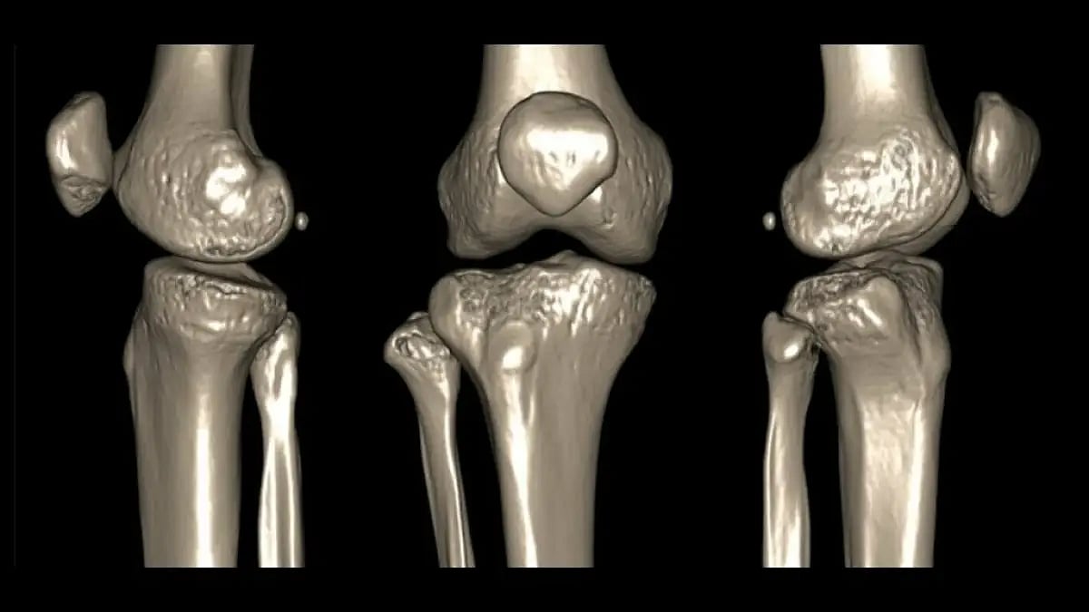 Vitamins for Cracking Knees and Popping Joints Expert Advice