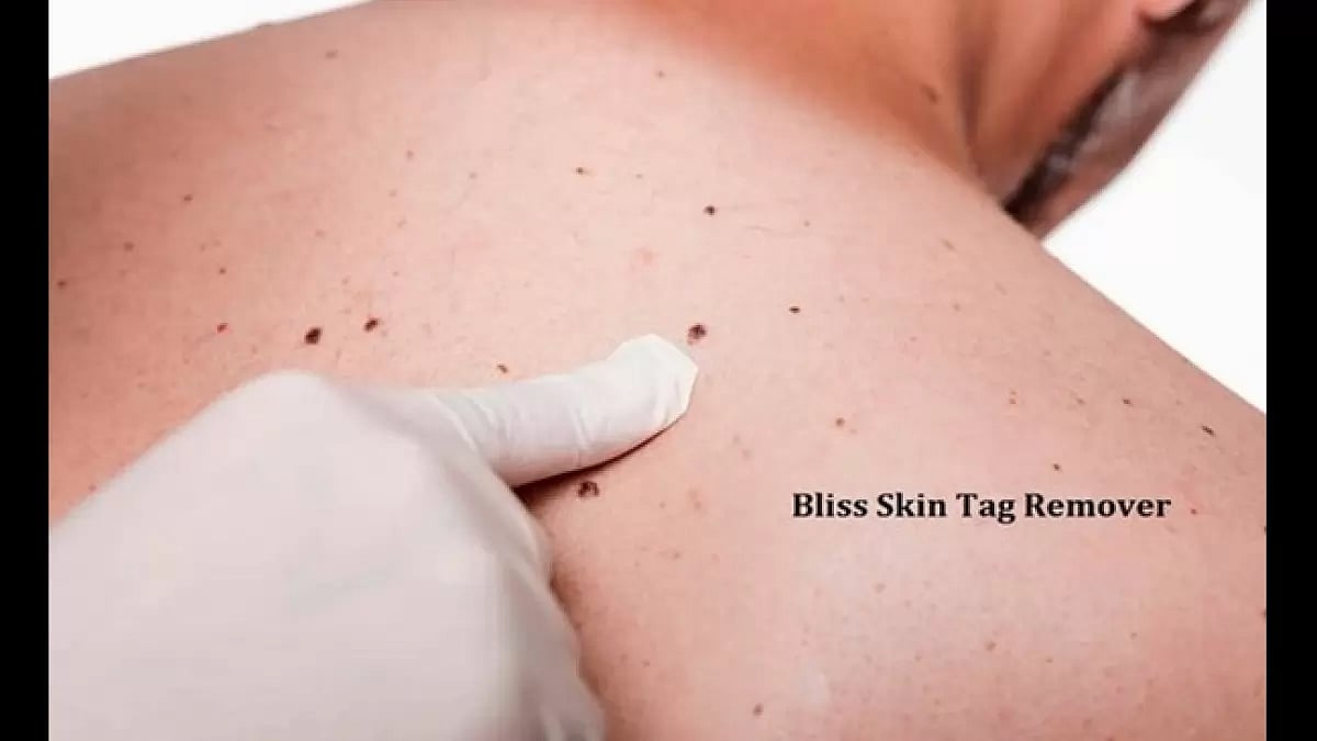 Bliss Skin Tag Remover 