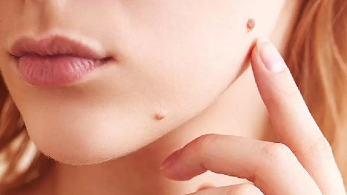 Bliss Skin Tag Remover Review 