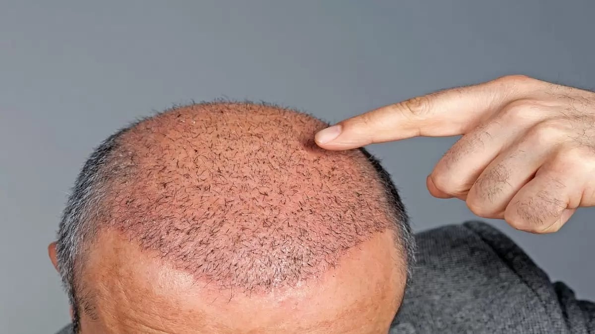 Hair Transplant Clinic and Hair Transplant Costs In Turkey