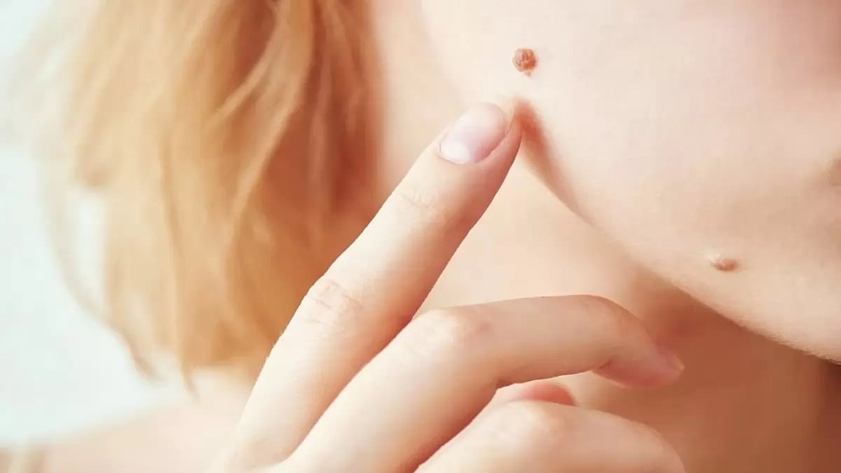 Best Over The Counter Mole Removal Serums