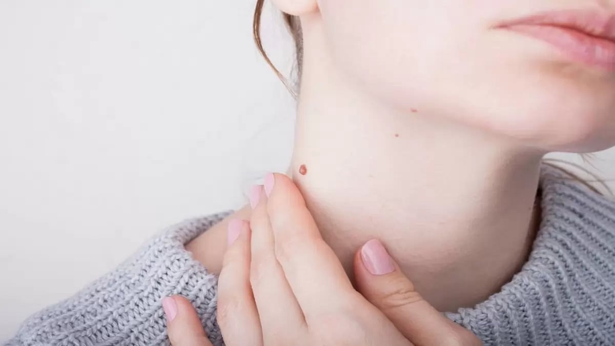 Over The Counter Skin Tag Removal Serums