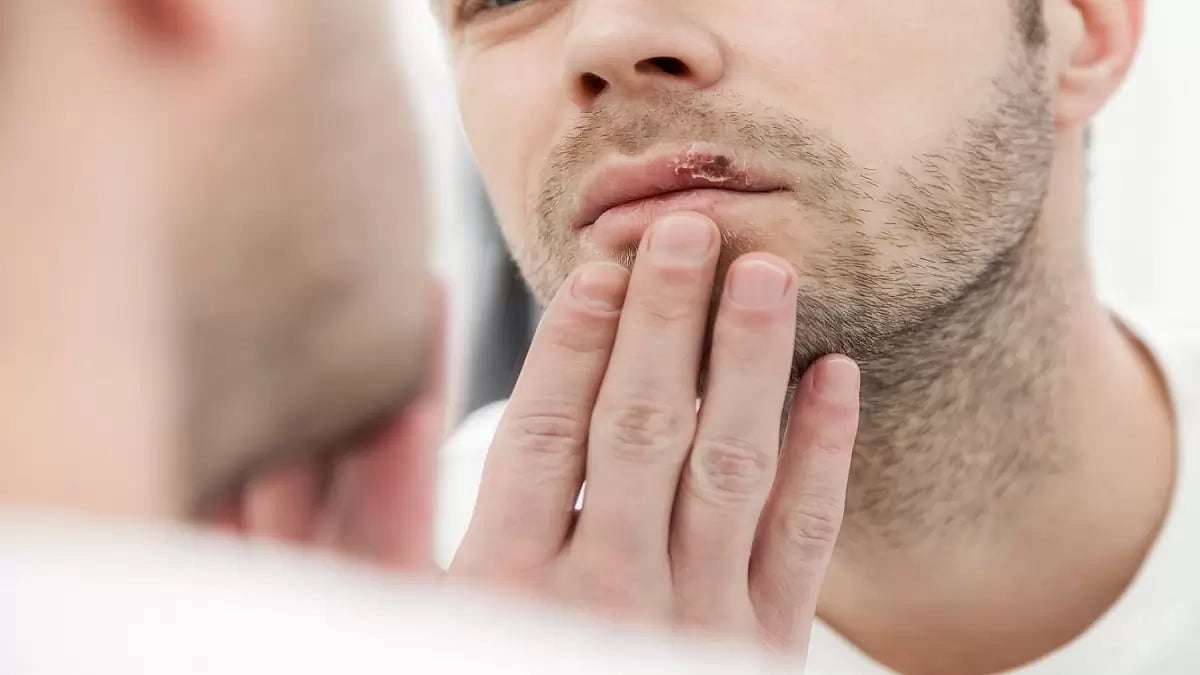 Top OTC Supplements To Get Rid Of Herpes