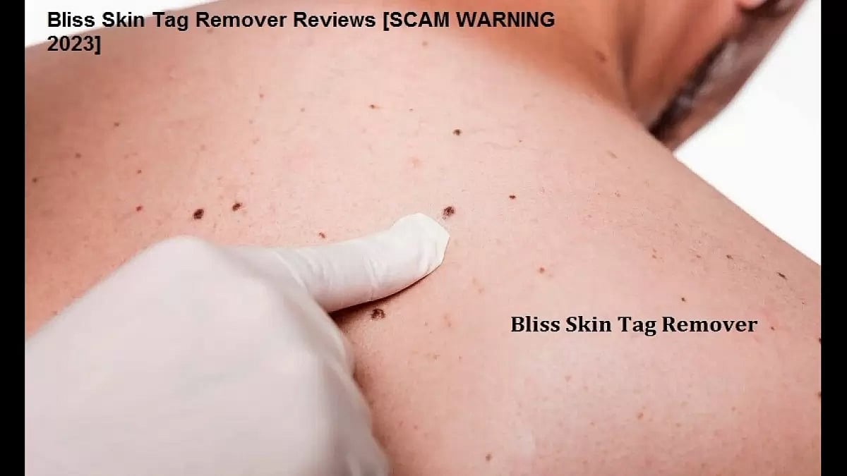 Bliss Skin Tag Remover 