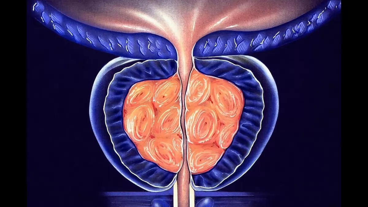 Best Prostate Supplements