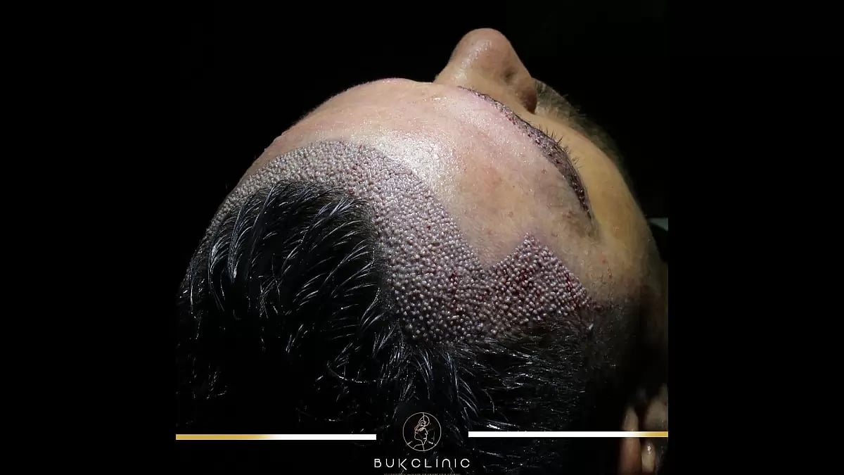Hair Transplant