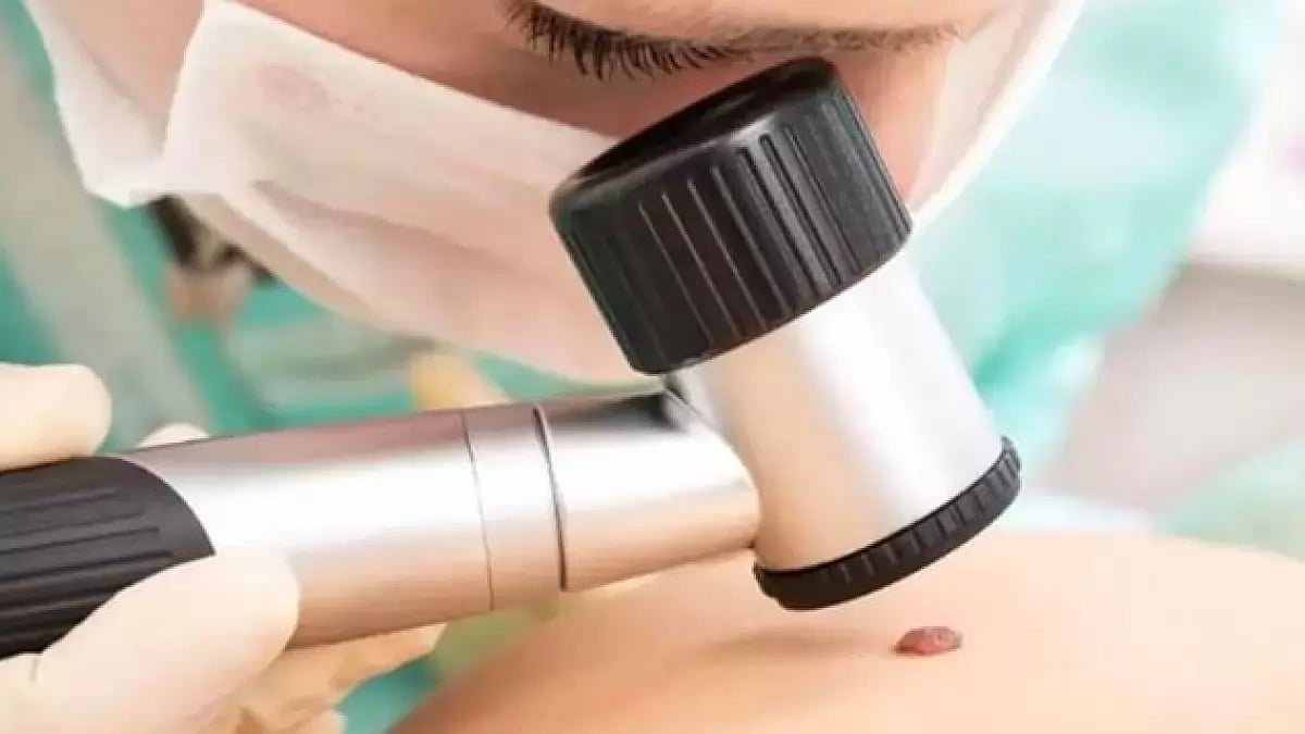 Paradise Skin Tag Remover