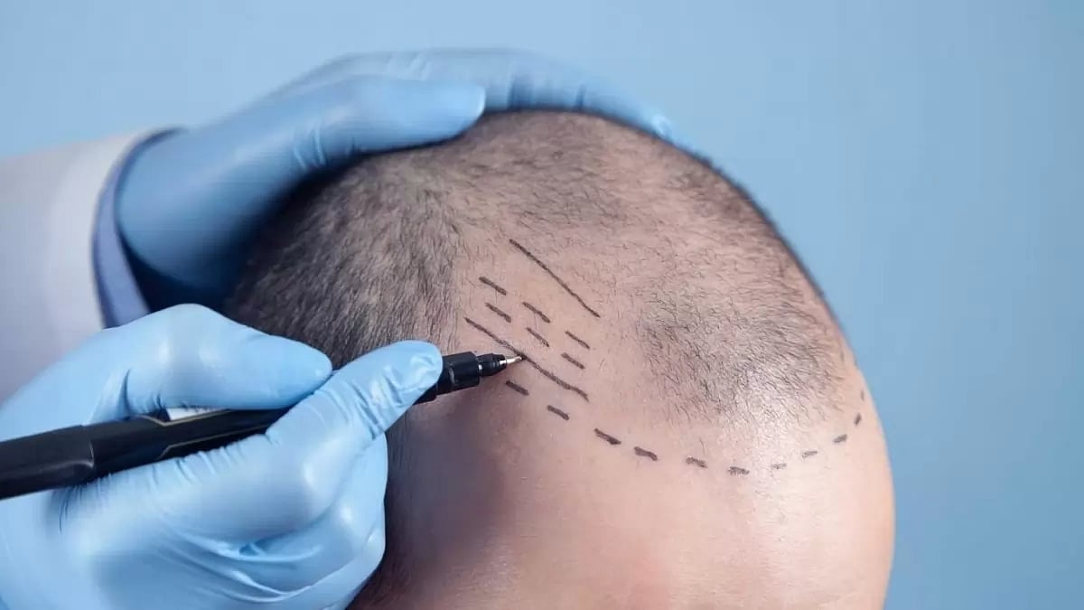 Best Hair Transplant In Turkey, Istanbul