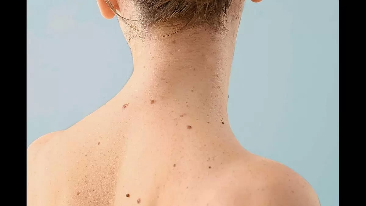 Best Skin Tag Removers