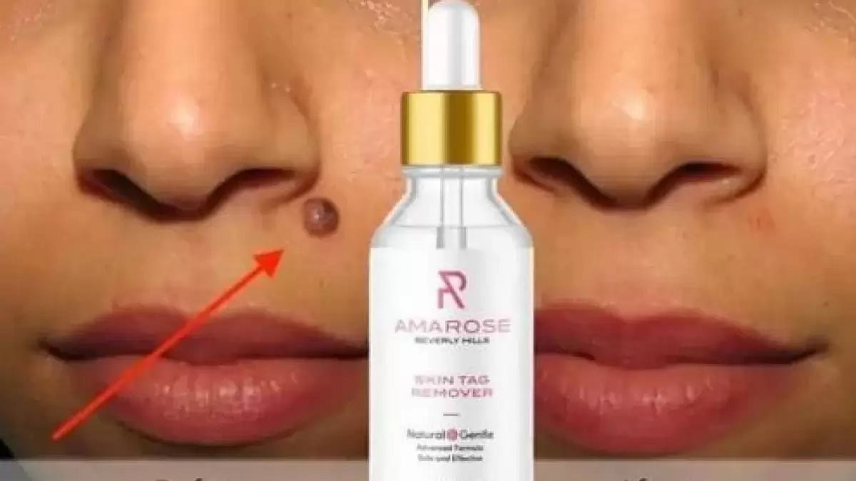 Amarose Skin Tag Remover