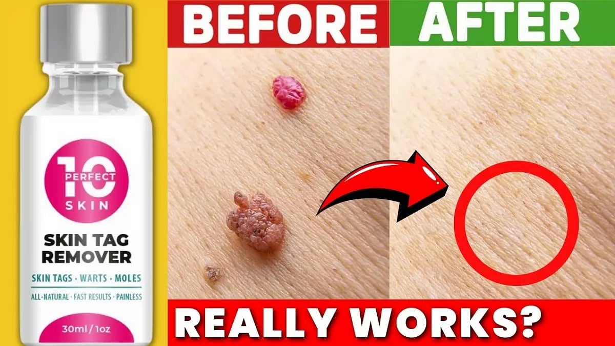 Perfect 10 Skin Tag Remover