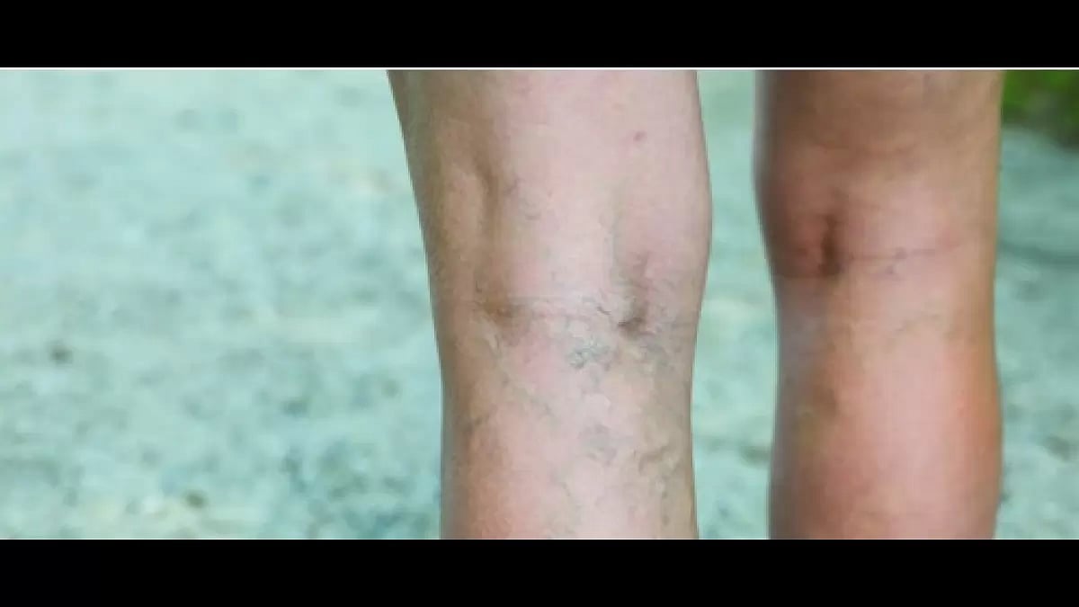 Cream For Varicose Veins