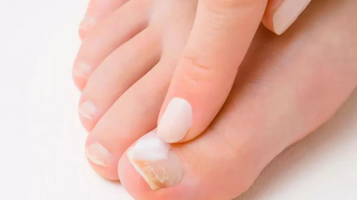 Toenail Fungus