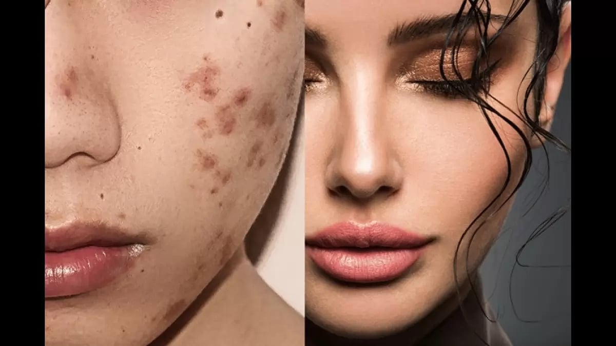 Best Skin Tag Remover 