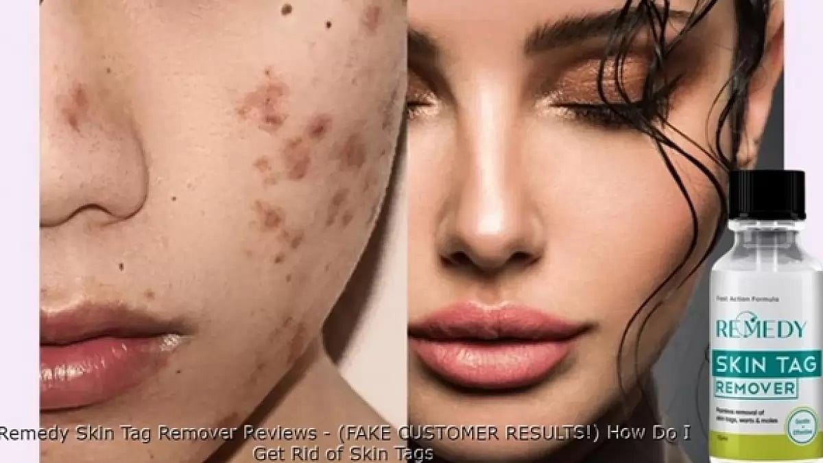 Remedy Skin Tag Remover