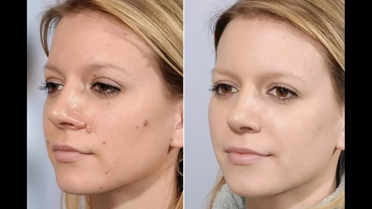 Utopia Skin Tag Remover 