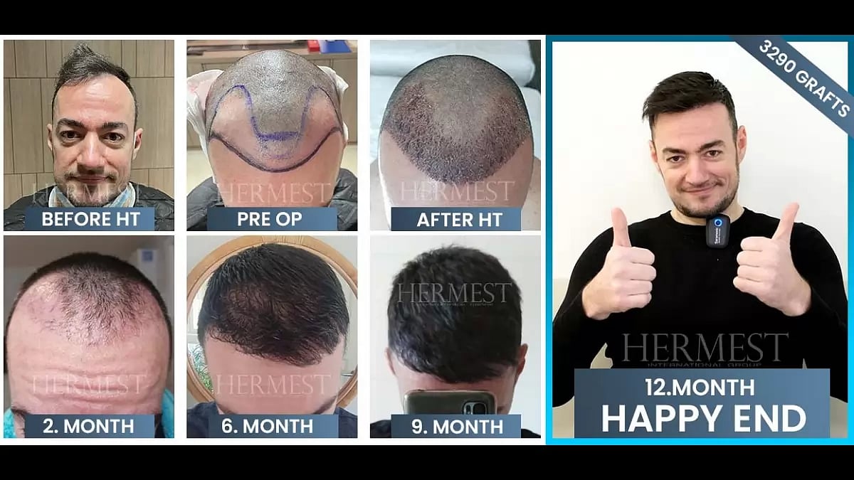 A hair transplant in Turkey before and after picture
