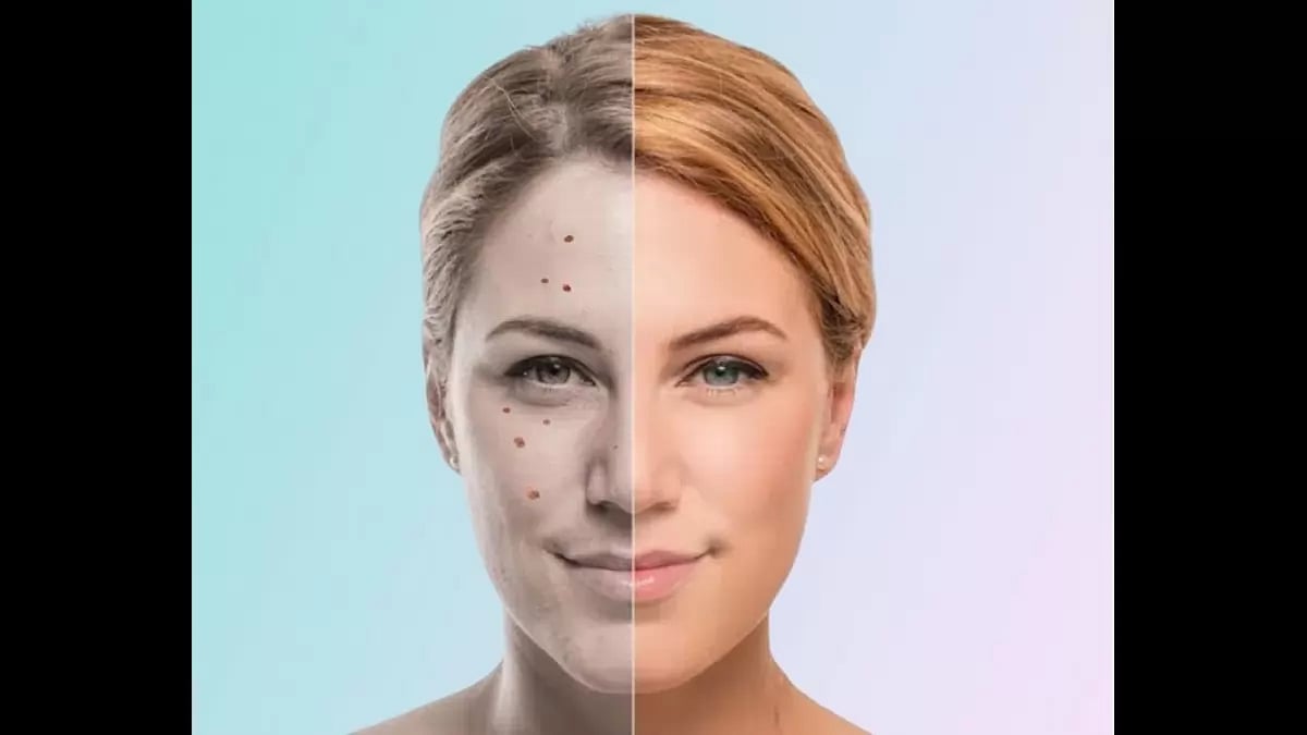 Shark Tank Skin Tag Remover Reviews 