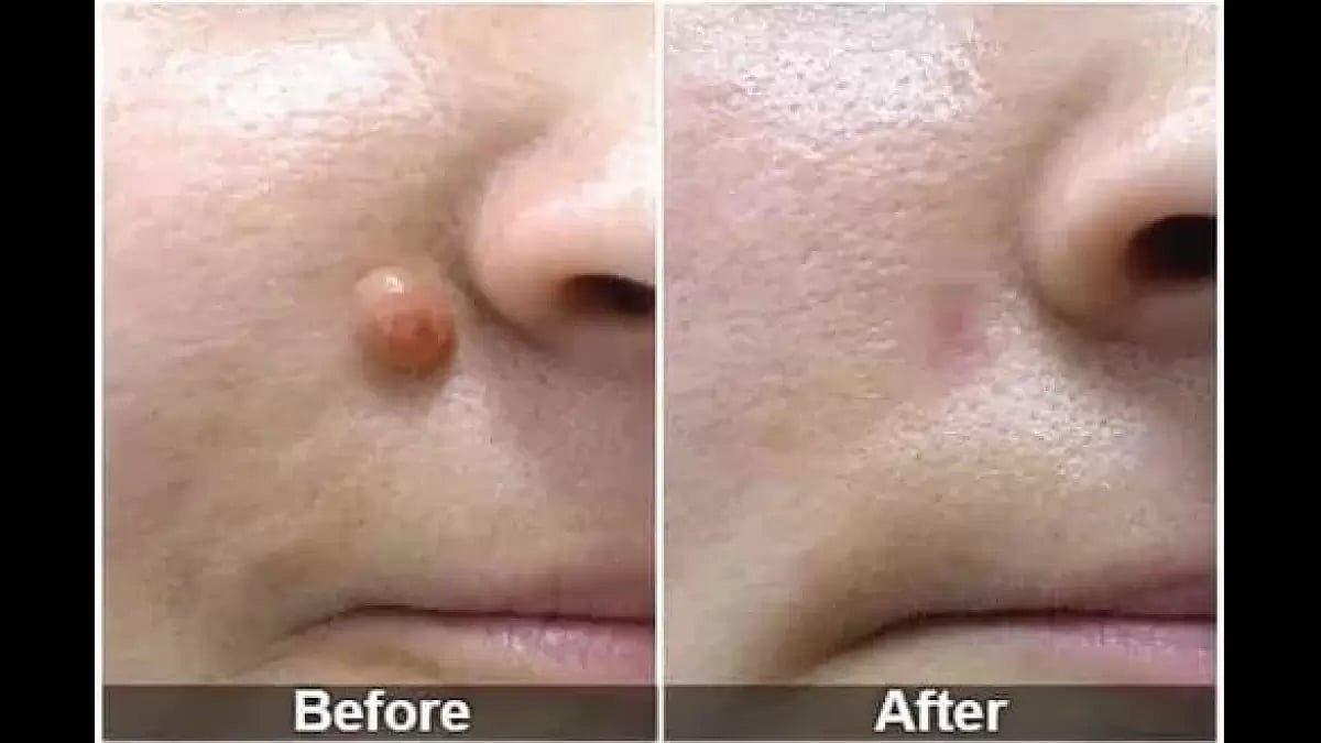 Utopia Skin Tag Remover Reviews 