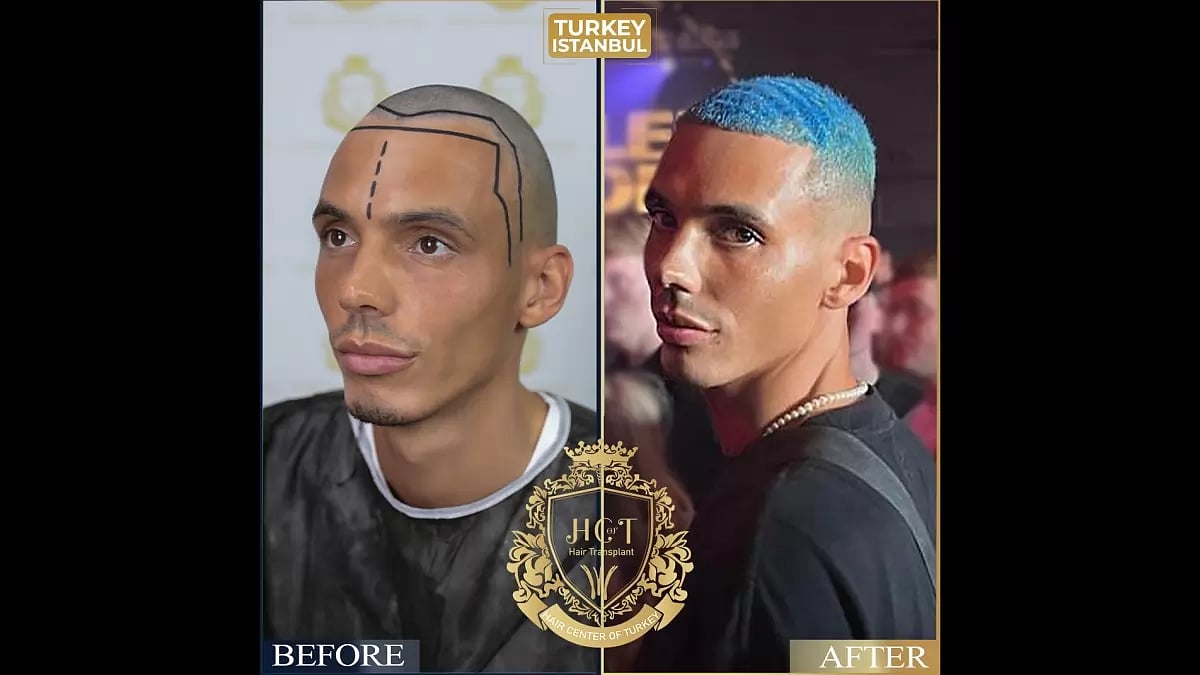 Hair Transplant Before And After - Hair Center Of Turkey