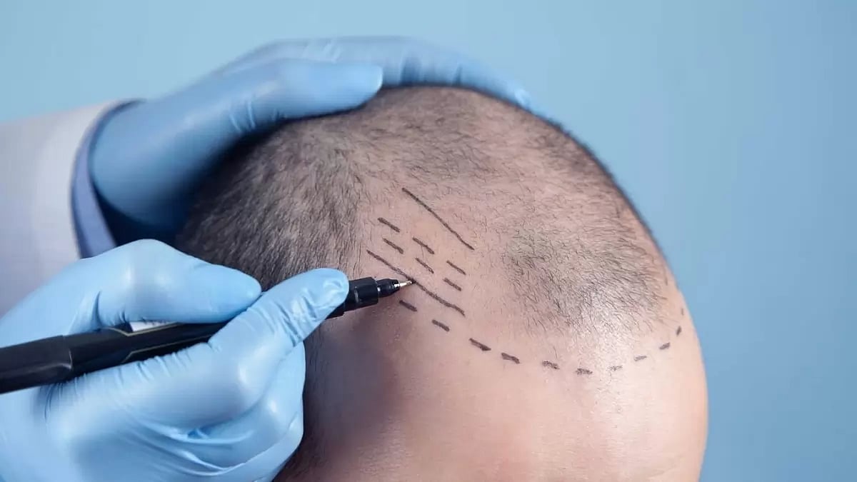Hair Transplant Packages Costs In Turkey