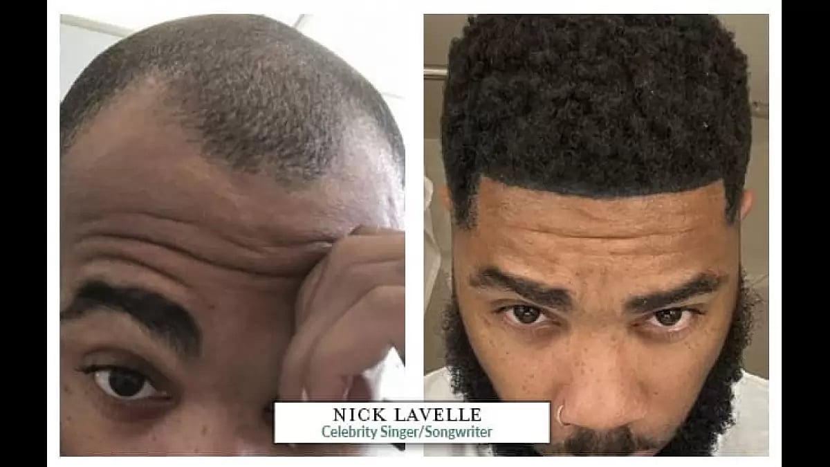 Hair Transplant