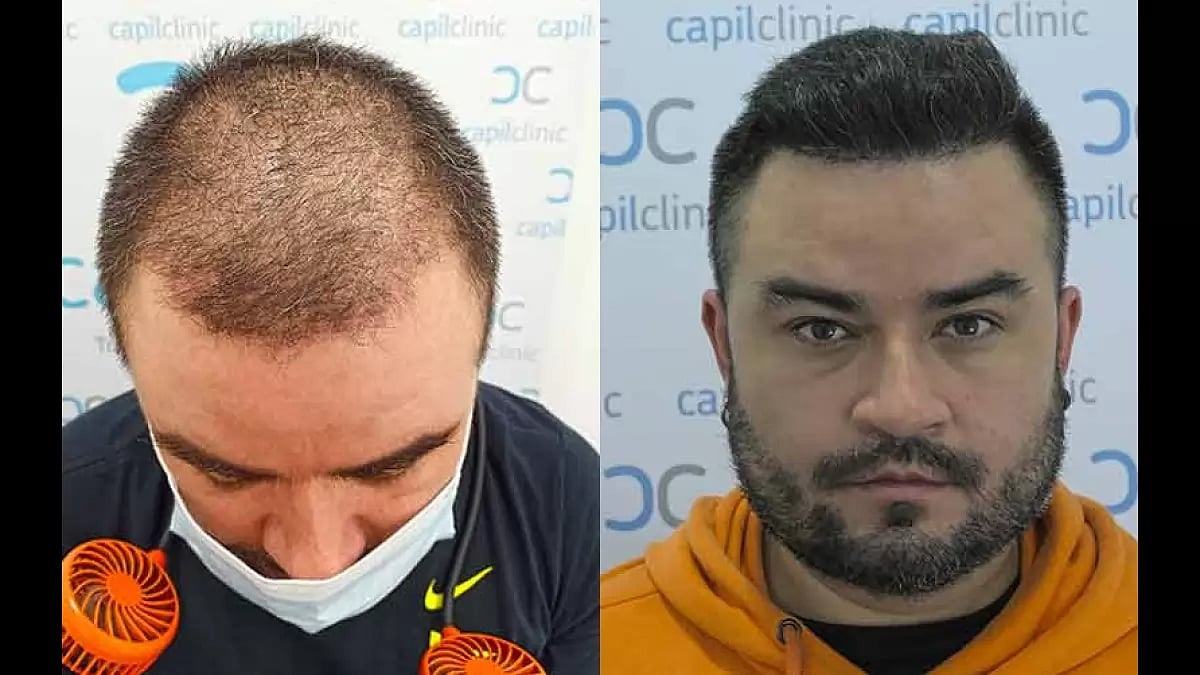 Hair transplant in the UK