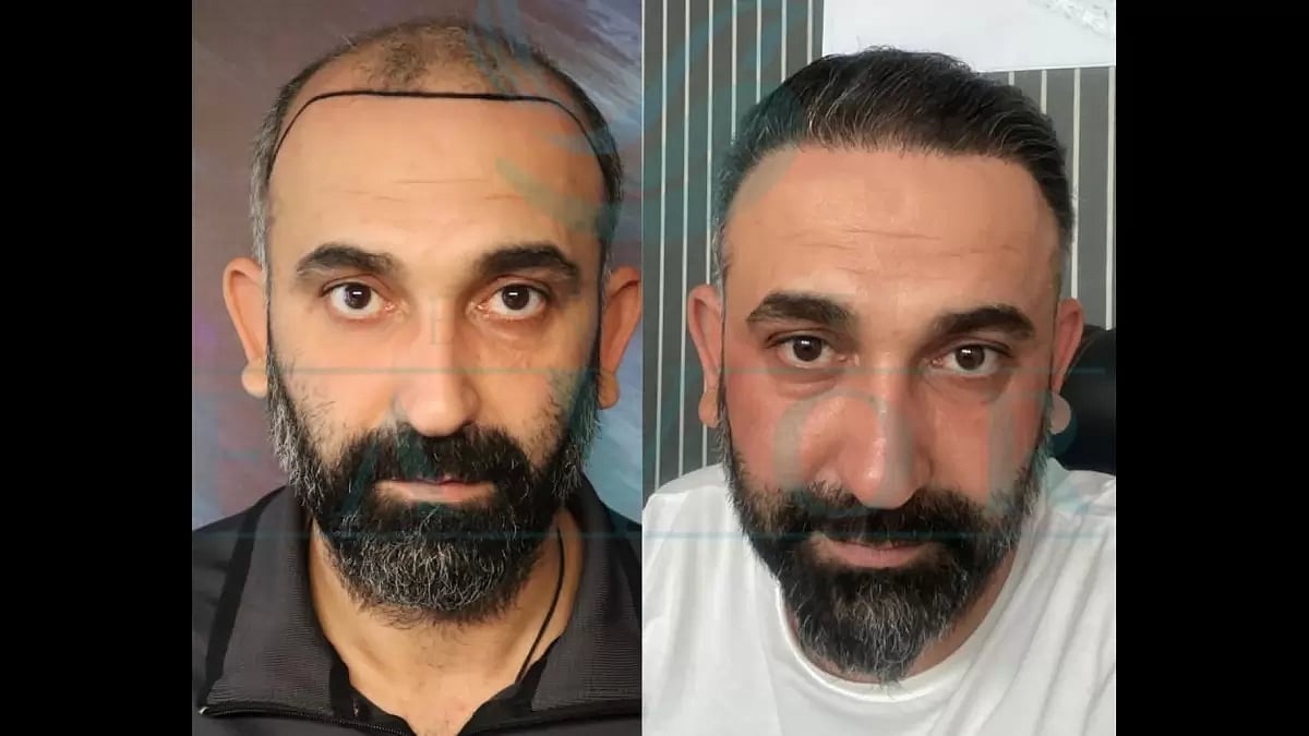 Hair Transplantation