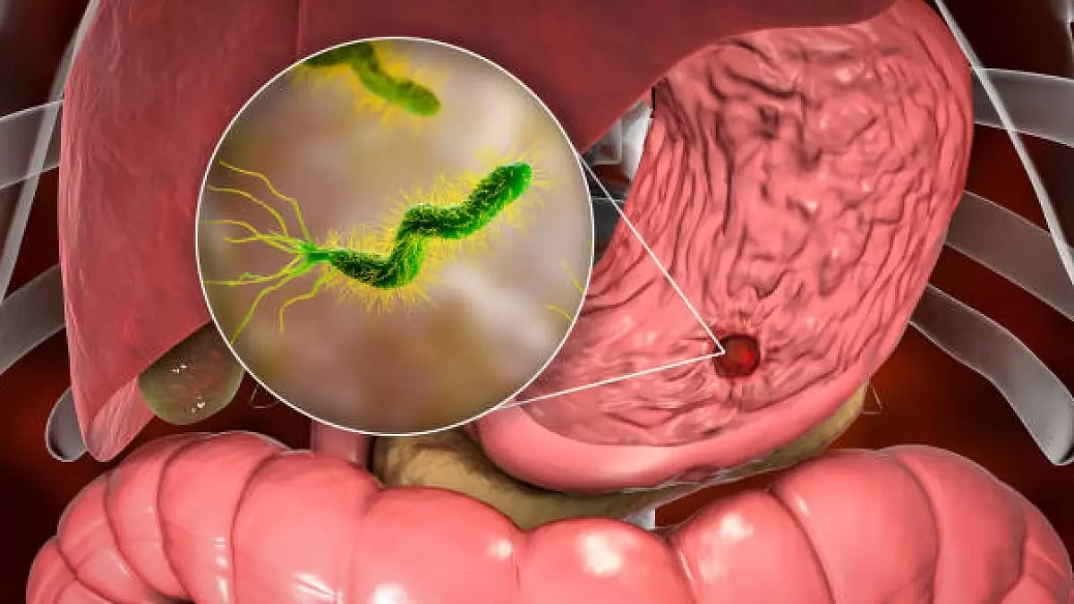 Risk factors, and modern strategies for managing Peptic Ulcer Disease (PUD)