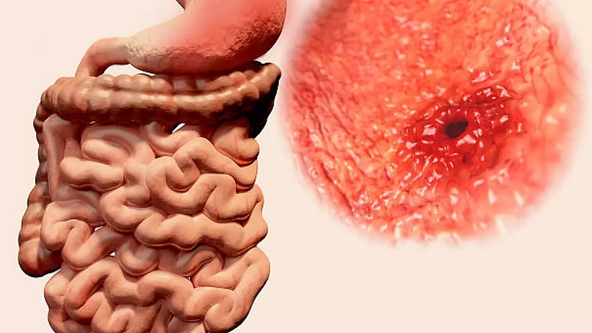 Peptic Ulcer Disease (PUD)