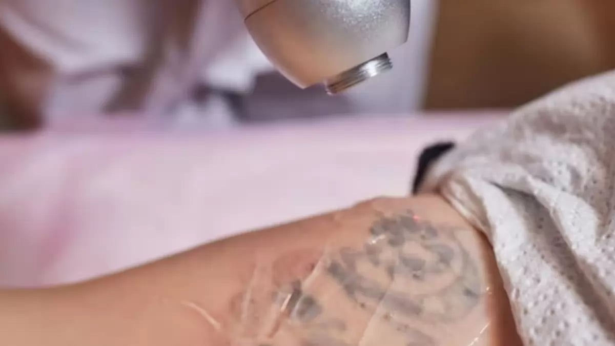 Tattoo removal in the US