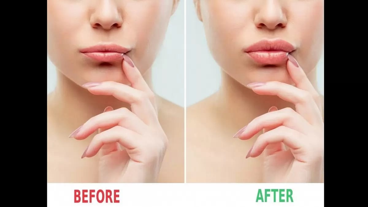 2023 Top 10 Best Lip Filler and Botox Clinic In Turkey, Istanbul And The Cost List