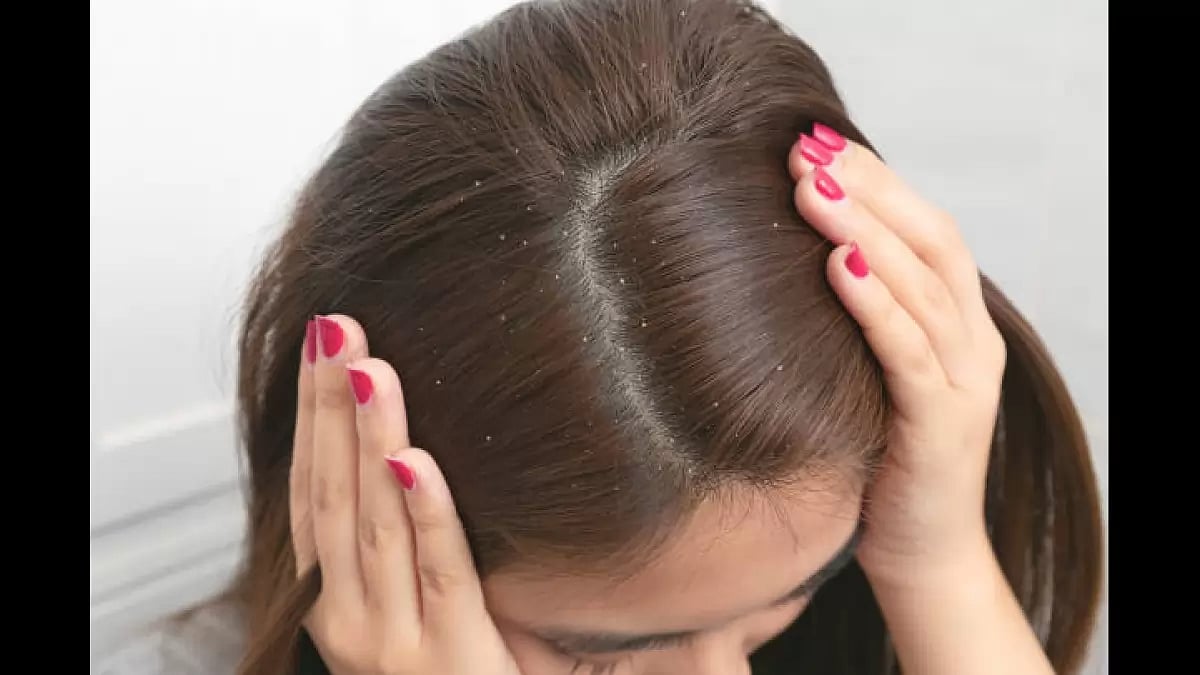 Get Rid of Dandruff With the Best Shampoos