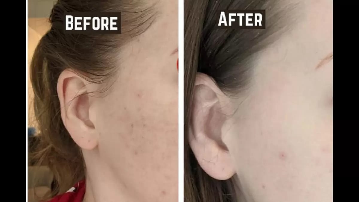 Get tretinoin Prescription Online