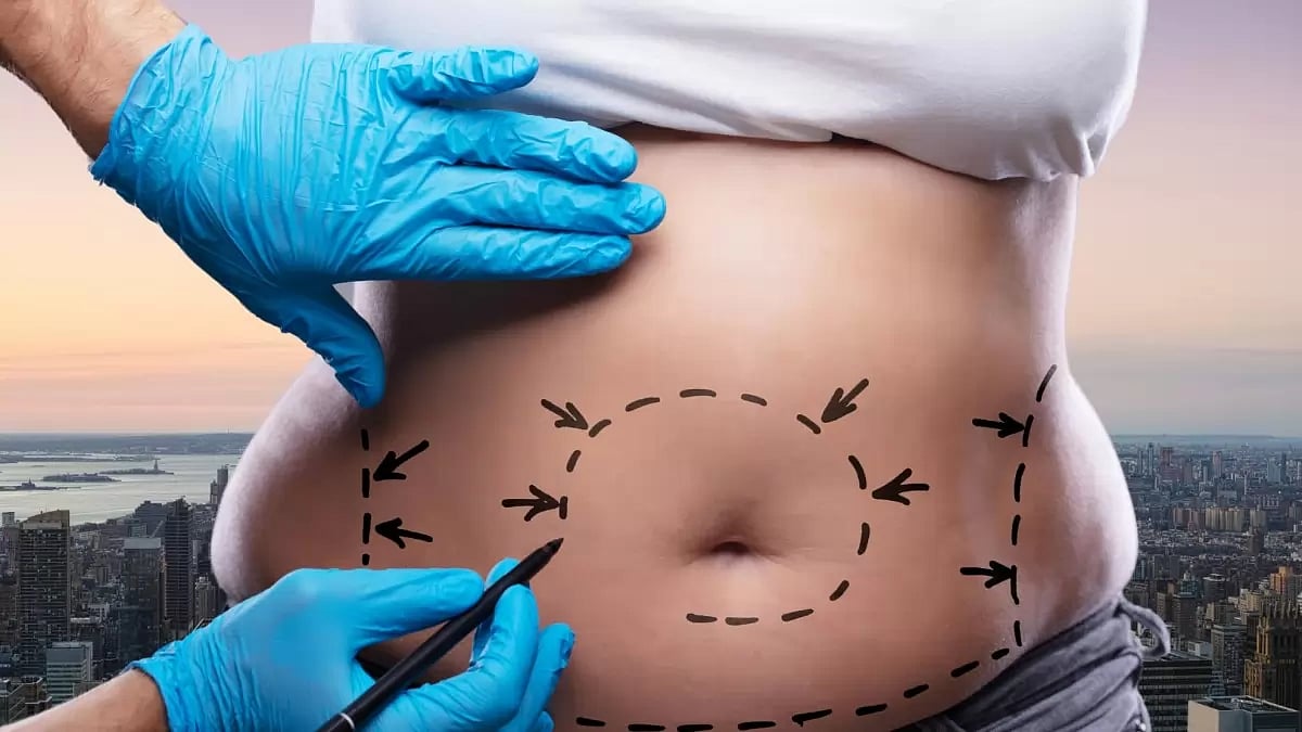 Best Liposuction NYC 