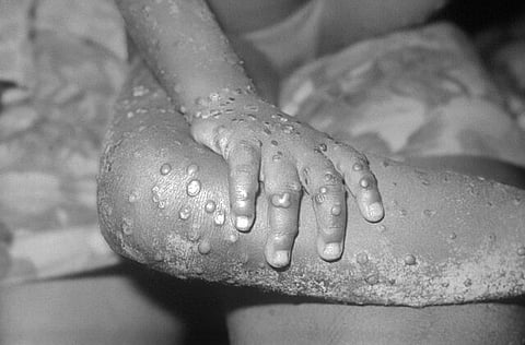 Skin lesions are a sign of mpox