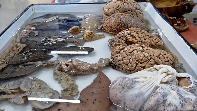 The Neuropathology Brain Museum was established to remove the stigma that’s associated with neuropsychiatric illness