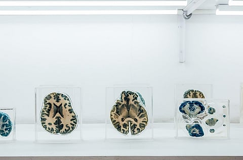 A display of brain specimens at the Neuropathology Brain Museum