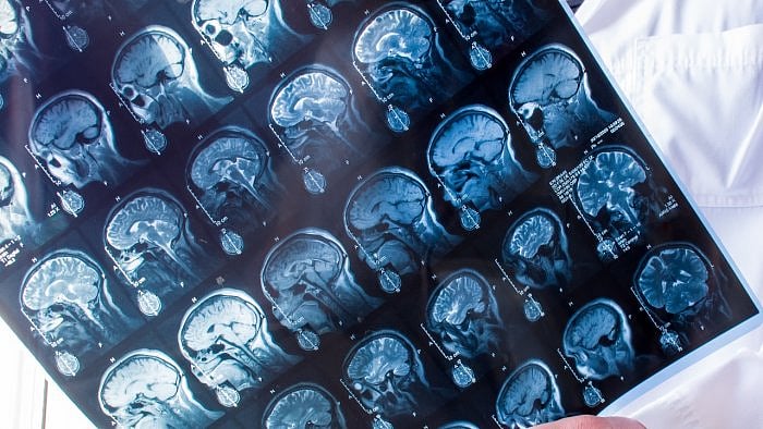 World Brain Tumor Day : ಬ್ರೈನ್‌ ಟ್ಯೂಮರ್‌ ಬಗ್ಗೆ ಇರಲಿ ಜಾಗೃತಿ