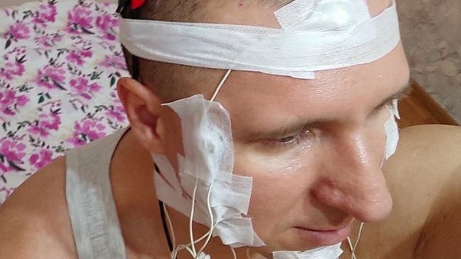 ಕನಸುಗಳ ನಿಯಂತ್ರಣಕ್ಕೆ ತಲೆಯೊಳಗೆ ಚಿಪ್‌ ಸೇರಿಸಲು ಹೋಗಿ ಆಸ್ಪತ್ರೆ ಸೇರಿದ ವ್ಯಕ್ತಿ