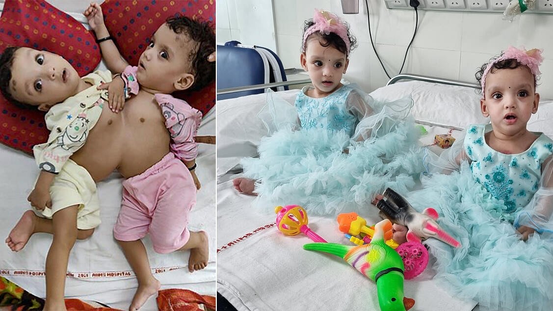 12 ತಾಸು ಶಸ್ತ್ರಚಿಕಿತ್ಸೆ: ಸಯಾಮಿ ಮಕ್ಕಳನ್ನು ಬೇರ್ಪಡಿಸಿದ ಏಮ್ಸ್‌ ವೈದ್ಯರು