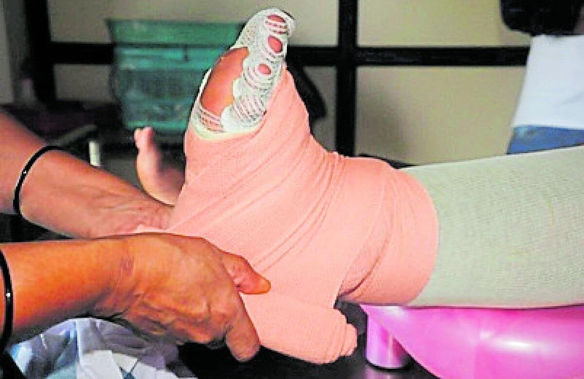 ಆನೆಕಾಲು ರೋಗಕ್ಕೆ ಸಂಯೋಜಿತ ಚಿಕಿತ್ಸಾ ವಿಧಾನ: ಕಾಸರಗೋಡಿನ ಐಎಡಿ ಸಂಶೋಧನೆ