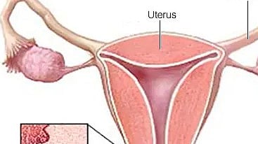ಗರ್ಭಕಂಠ ಕ್ಯಾನ್ಸರ್: ಲಕ್ಷಣಗಳೇನು? ಪತ್ತೆ, ತಡೆ ಹೇಗೆ?