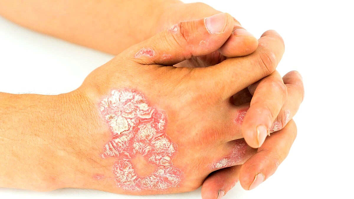 ಆರೋಗ್ಯ: ಸೋರಿಯಾಸಿಸ್‌ನ ಕಿರಿಕಿರಿಗಳು.. ಪರಿಹಾರವೇನು?