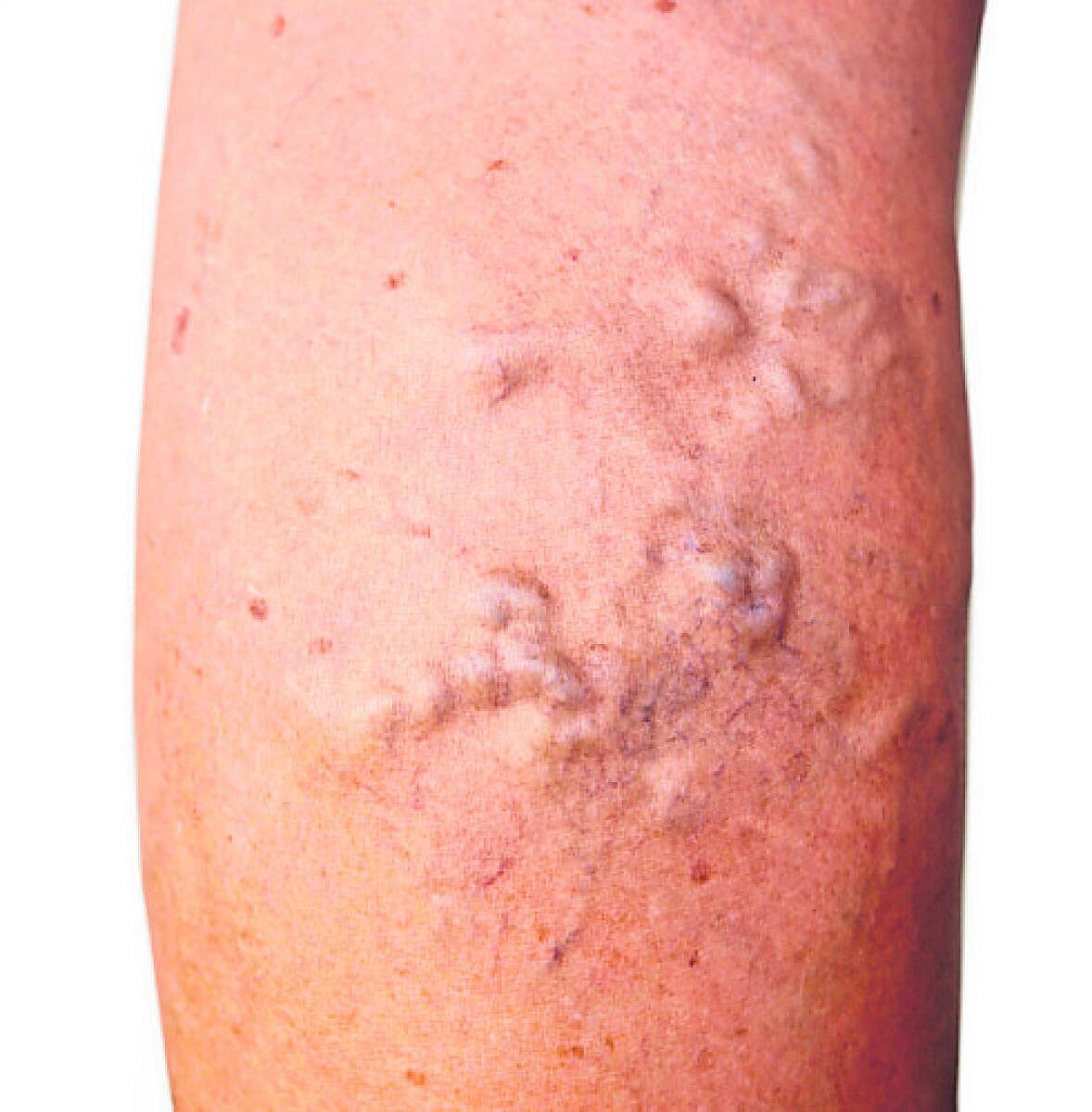 ಕ್ಷೇಮ–ಕುಶಲ: ವೆರಿಕೋಸ್; ಉಬ್ಬಿದ ರಕ್ತನಾಳಗಳು